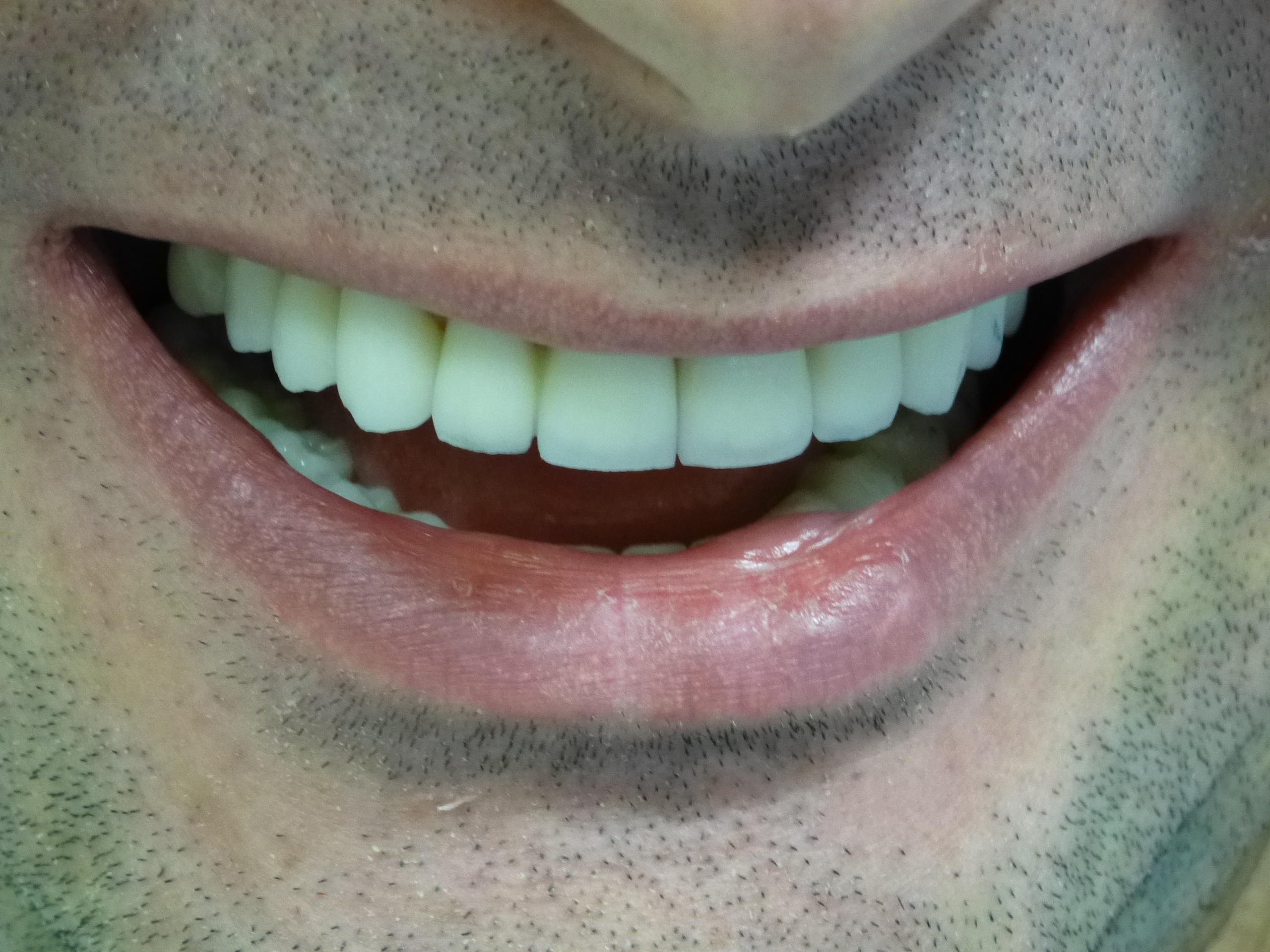 Комплексная работа по восстановлению эстетики зубных рядов