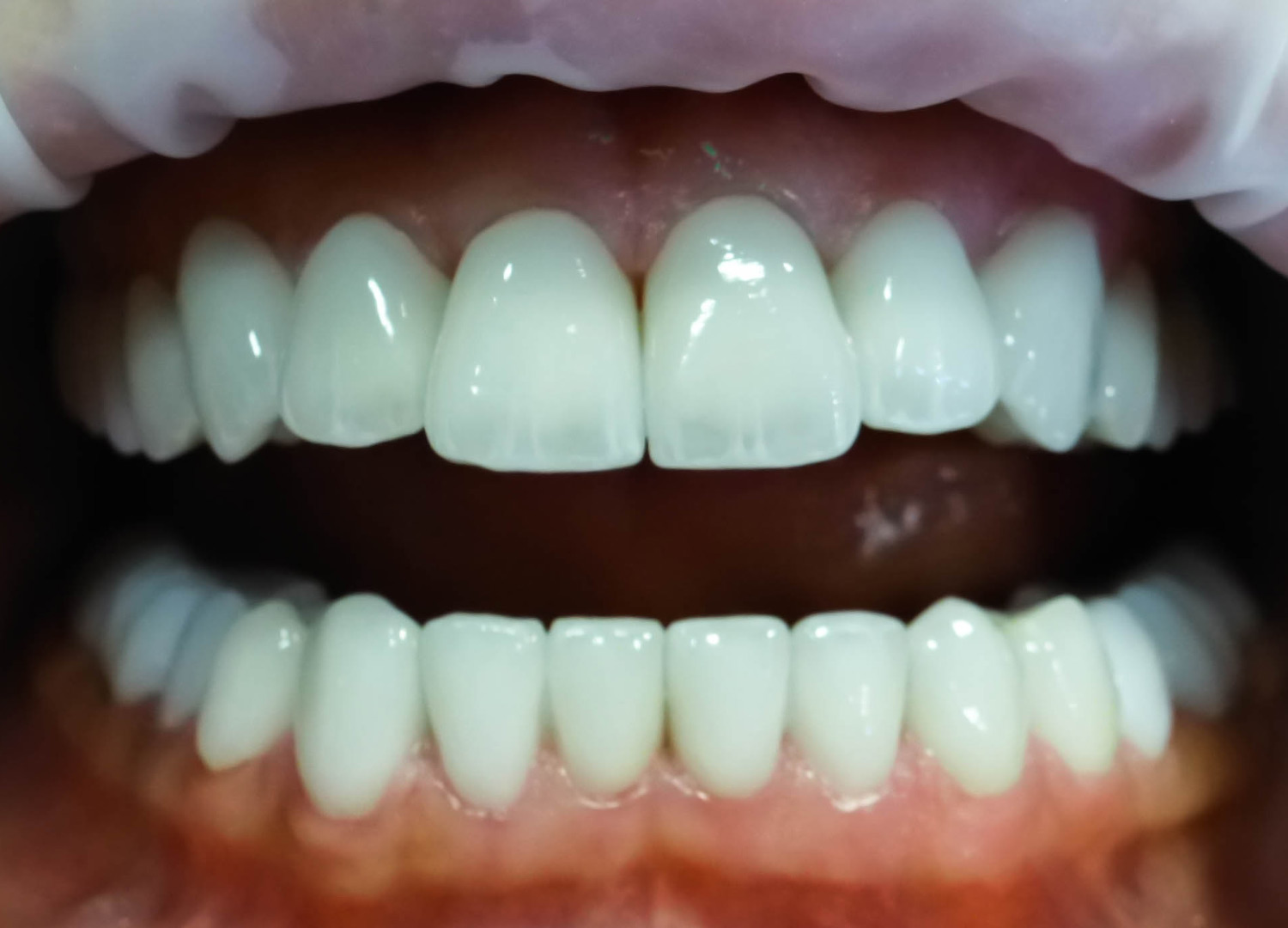 Эстетическая стоматология в действии: создание нового дизайна улыбки с коронками из диоксида циркония