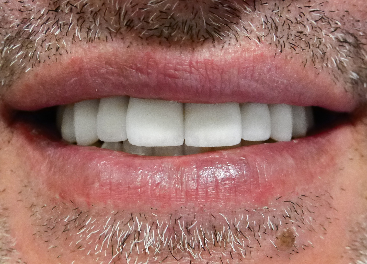 Восстановление зоны улыбки после перелома челюсти