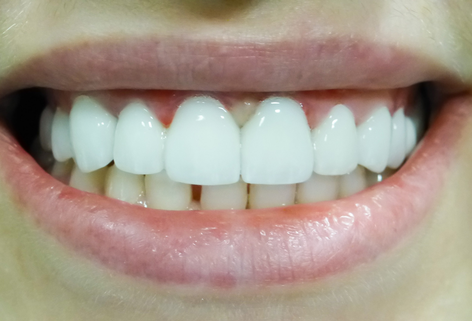 Протезирование зубов коронками из диоксида циркония и Prettau Zirkon